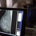 Plano de saúde terá que cobrir mamografia digital para todas as idades 